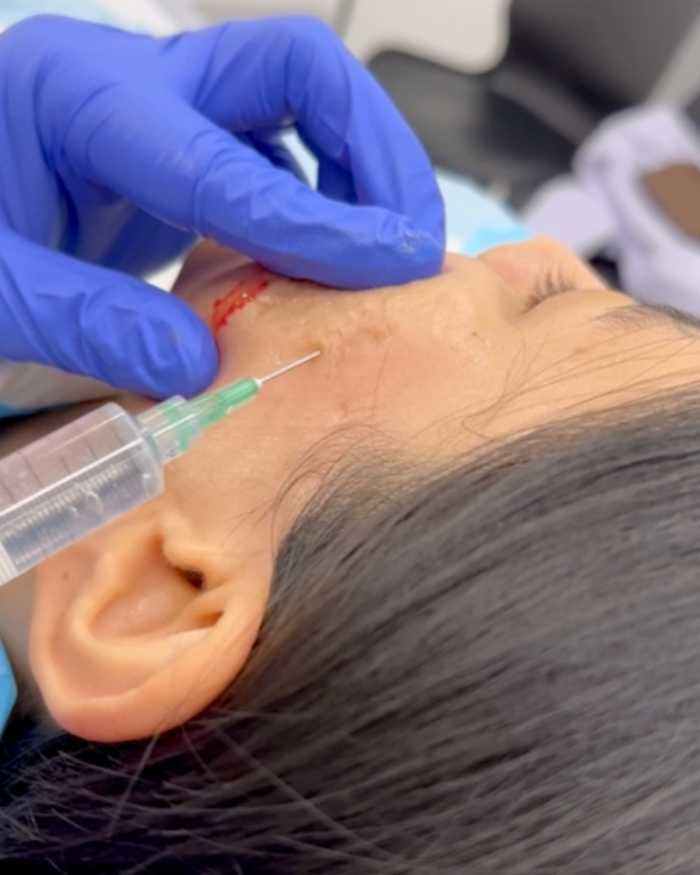 Subcision – Southern Dermatology